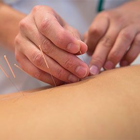 hands inserting acupuncture needles into patient back